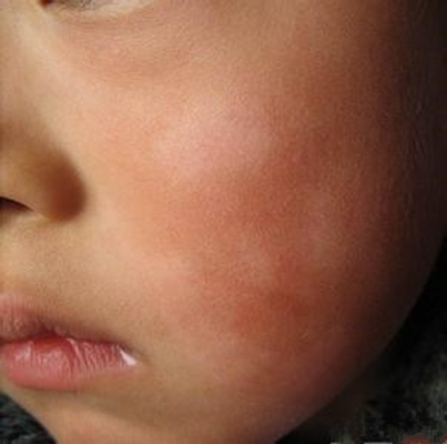 宝宝脸上的 &ldquo;小白斑&rdquo; 别慌！一文读懂白色糠疹