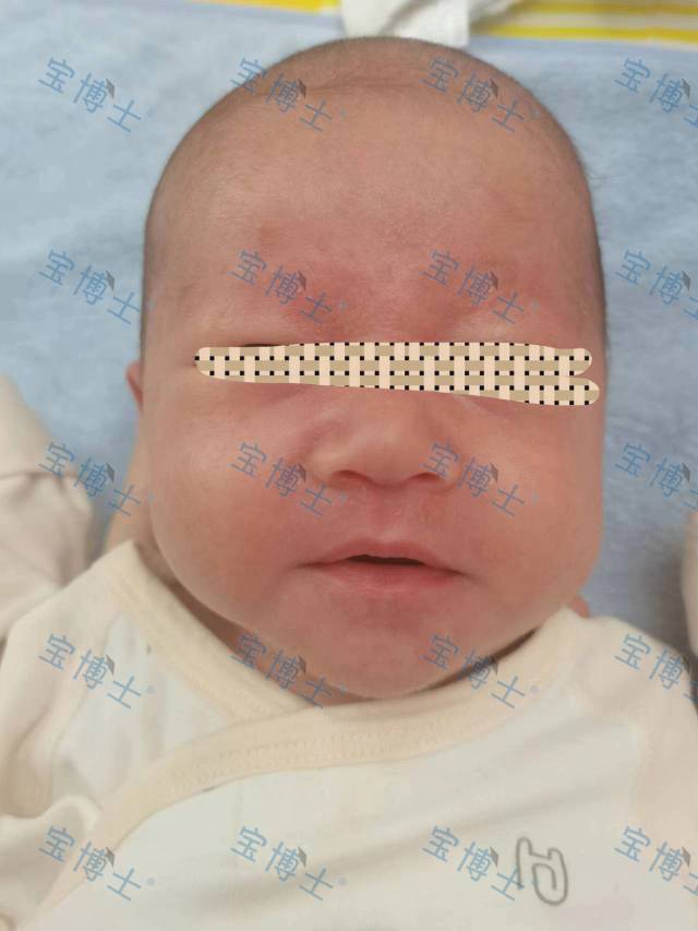 刚出月子的湿疹宝宝，眉毛脸部胎垢很厚和湿疹好严重🥹🥹🥹