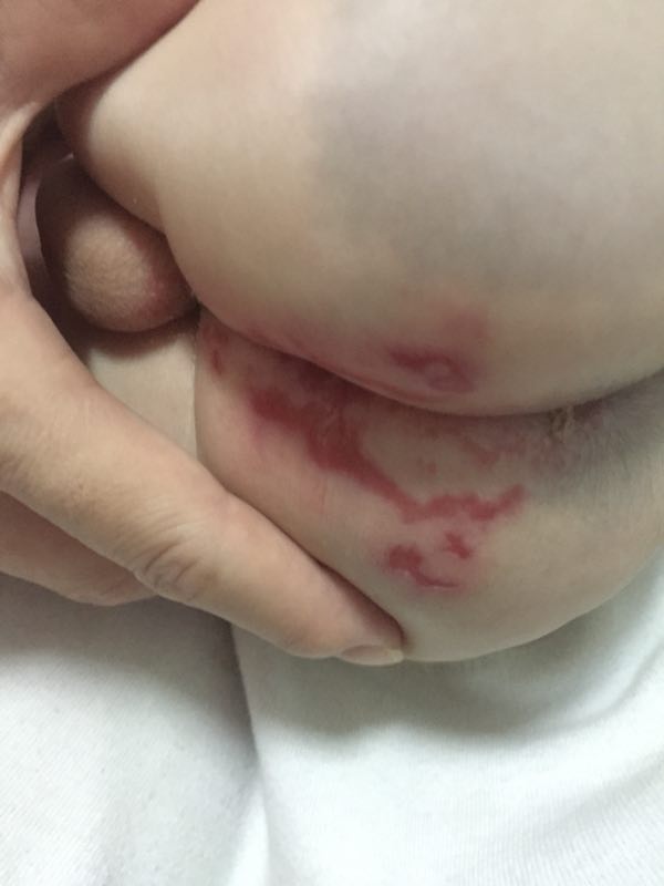 二宝PP破皮到裂开，我心疼得泪崩！这款护理膏救急，强烈推荐给新手妈妈！